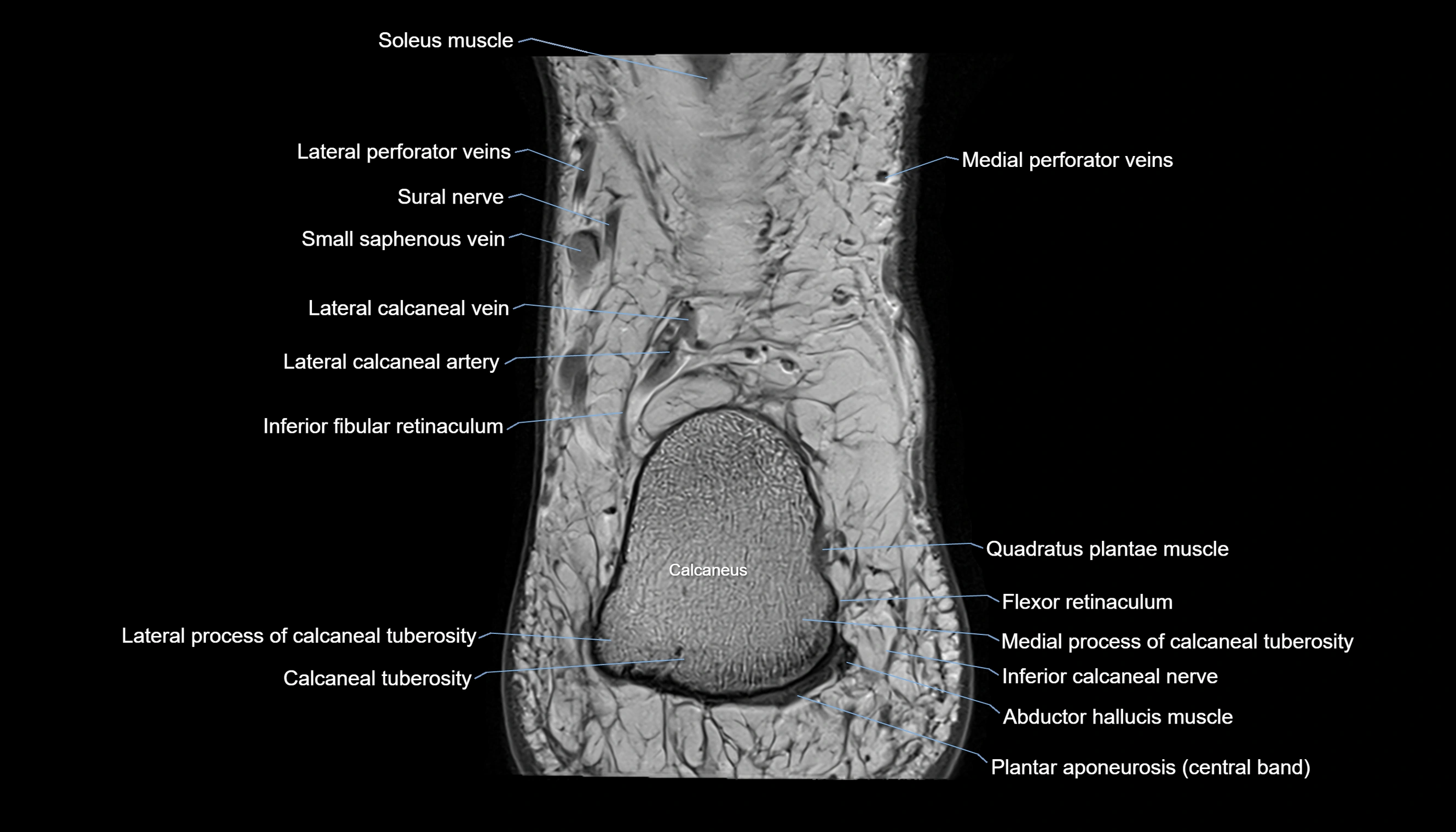 Ankle coronal anatomy 3T MRI images -img-11001-00026.webp